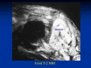tumor




Axial T-2 MRI
 