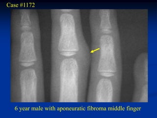 Case #1172




  6 year male with aponeuratic fibroma middle finger
 