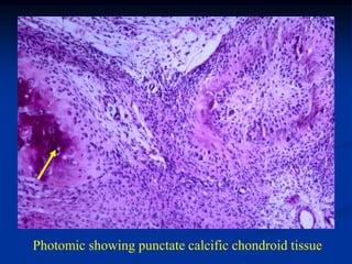 Photomic showing punctate calcific chondroid tissue
 