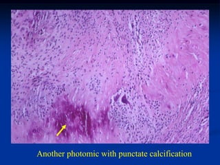 Another photomic with punctate calcification
 