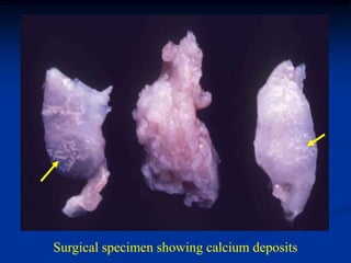 Surgical specimen showing calcium deposits
 