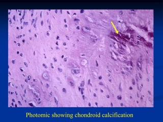 Photomic showing chondroid calcification
 