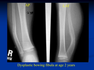 AP                       LAT




Dysplastic bowing fibula at age 2 years
 