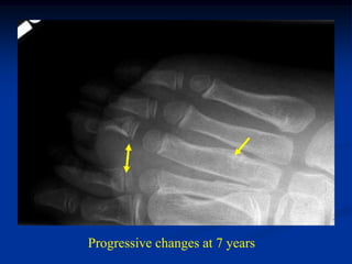 Progressive changes at 7 years
 