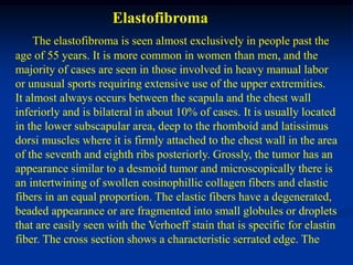 Elastofibroma
     The elastofibroma is seen almost exclusively in people past the
age of 55 years. It is more common in women than men, and the
majority of cases are seen in those involved in heavy manual labor
or unusual sports requiring extensive use of the upper extremities.
It almost always occurs between the scapula and the chest wall
inferiorly and is bilateral in about 10% of cases. It is usually located
in the lower subscapular area, deep to the rhomboid and latissimus
dorsi muscles where it is firmly attached to the chest wall in the area
of the seventh and eighth ribs posteriorly. Grossly, the tumor has an
appearance similar to a desmoid tumor and microscopically there is
an intertwining of swollen eosinophillic collagen fibers and elastic
fibers in an equal proportion. The elastic fibers have a degenerated,
beaded appearance or are fragmented into small globules or droplets
that are easily seen with the Verhoeff stain that is specific for elastin
fiber. The cross section shows a characteristic serrated edge. The
 