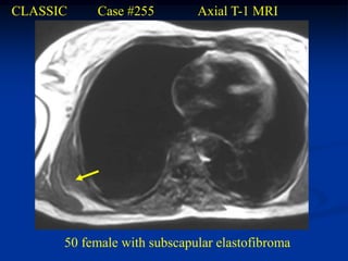 CLASSIC    Case #255         Axial T-1 MRI




      50 female with subscapular elastofibroma
 