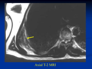 Axial T-2 MRI
 