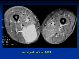 Axial gad contrast MRI
 