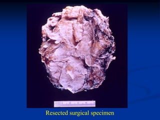 Resected surgical specimen
 