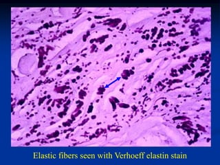 Elastic fibers seen with Verhoeff elastin stain
 