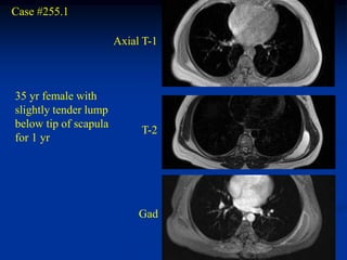 Case #255.1

                       Axial T-1



35 yr female with
slightly tender lump
below tip of scapula
                            T-2
for 1 yr




                            Gad
 