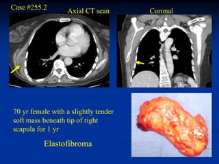 Case #255.2       Axial CT scan       Coronal




70 yr female with a slightly tender
soft mass beneath tip of right
scapula for 1 yr

          Elastofibroma
 
