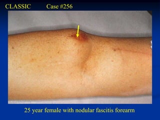 CLASSIC      Case #256




     25 year female with nodular fascitis forearm
 