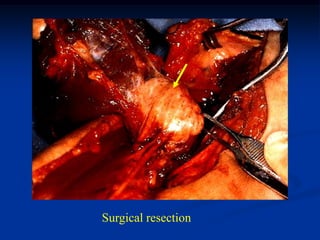 Surgical resection
 