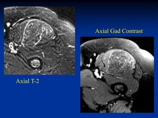 Axial Gad Contrast




Axial T-2
 