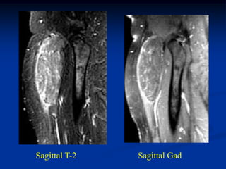 Sagittal T-2   Sagittal Gad
 