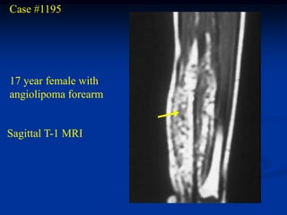 Case #1195




17 year female with
angiolipoma forearm


Sagittal T-1 MRI
 