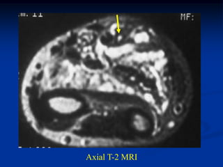 Axial T-2 MRI
 