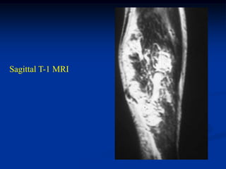 Sagittal T-1 MRI
 