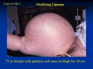 Case #1196.1          Ossifying Lipoma




 75 yr female with painless soft mass in thigh for 10 yrs
 