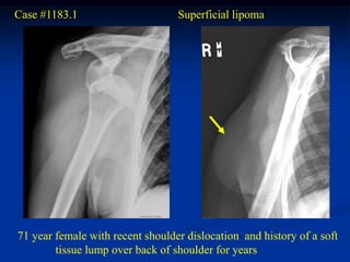 Case #1183.1                      Superficial lipoma




71 year female with recent shoulder dislocation and history of a soft
        tissue lump over back of shoulder for years
 