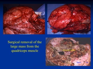 Surgical removal of the
 large mass from the
  quadriceps muscle       Necrotic tumor




                                           bone   fat
 