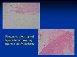 Photomics show typical
lipoma tissue covering
necrotic ossifying tissue
 