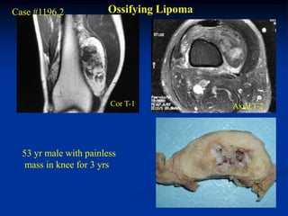 Case #1196.2           Ossifying Lipoma




                        Cor T-1           Axial T-2




  53 yr male with painless
   mass in knee for 3 yrs
 