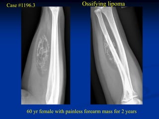Case #1196.3                     Ossifying lipoma




        60 yr female with painless forearm mass for 2 years
 