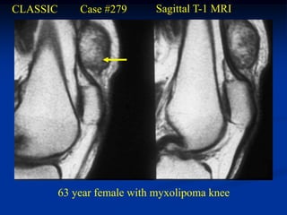 CLASSIC       Case #279      Sagittal T-1 MRI




          63 year female with myxolipoma knee
 