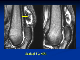 Sagittal T-2 MRI
 