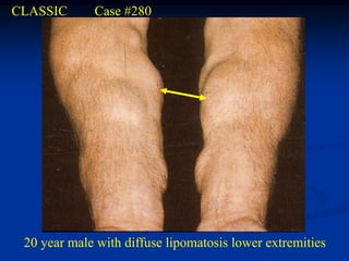 CLASSIC      Case #280




 20 year male with diffuse lipomatosis lower extremities
 