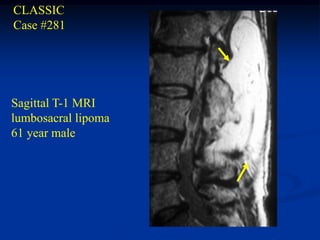 CLASSIC
Case #281




Sagittal T-1 MRI
lumbosacral lipoma
61 year male
 