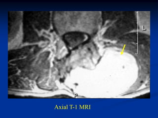 Axial T-1 MRI
 