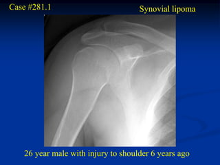 Case #281.1                         Synovial lipoma




   26 year male with injury to shoulder 6 years ago
 