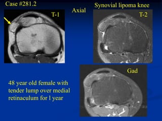 Case #281.2                        Synovial lipoma knee
                           Axial
                 T-1                                T-2




                                              Gad
 48 year old female with
 tender lump over medial
 retinaculum for l year
 