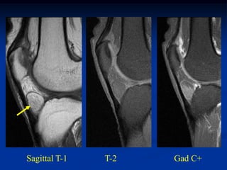 Sagittal T-1   T-2   Gad C+
 