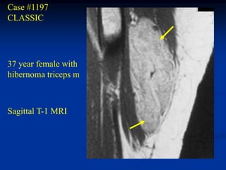 Case #1197
CLASSIC




37 year female with
hibernoma triceps m



Sagittal T-1 MRI
 