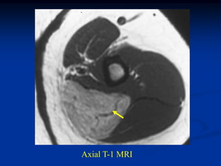 Axial T-1 MRI
 
