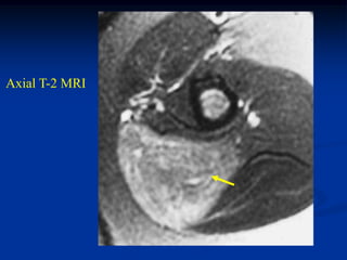 Axial T-2 MRI
 