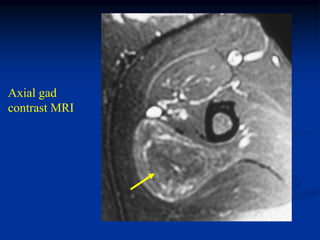 Axial gad
contrast MRI
 