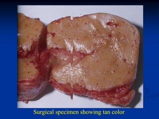 Surgical specimen showing tan color
 