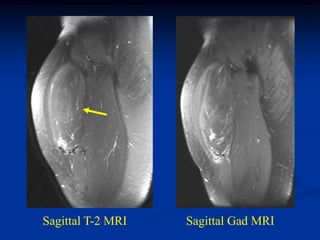 Sagittal T-2 MRI   Sagittal Gad MRI
 
