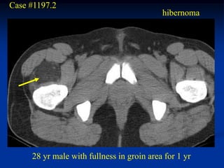 Case #1197.2
                                           hibernoma




     28 yr male with fullness in groin area for 1 yr
 