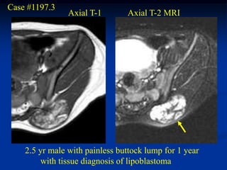 Case #1197.3
                Axial T-1       Axial T-2 MRI




    2.5 yr male with painless buttock lump for 1 year
        with tissue diagnosis of lipoblastoma
 