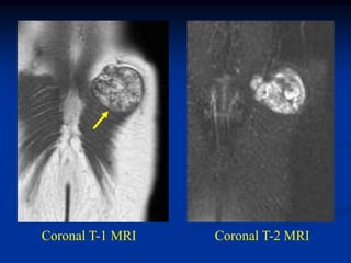 Coronal T-1 MRI   Coronal T-2 MRI
 