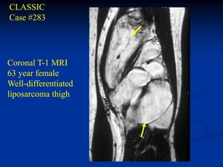CLASSIC
Case #283




Coronal T-1 MRI
63 year female
Well-differentiated
liposarcoma thigh
 