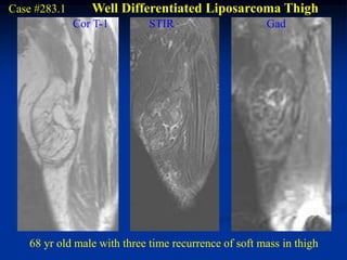 Case #283.1      Well Differentiated Liposarcoma Thigh
              Cor T-1         STIR                     Gad




    68 yr old male with three time recurrence of soft mass in thigh
 