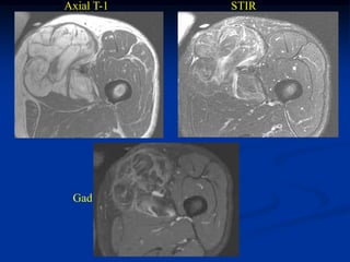Axial T-1   STIR




 Gad
 