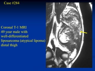 Case #284




Coronal T-1 MRI
49 year male with
well-differentiated
liposarcoma (atypical lipoma)
distal thigh
 